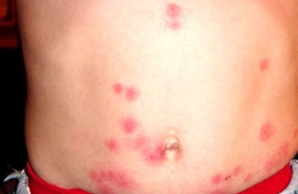 pogryzienia-pluskiew-brzuch