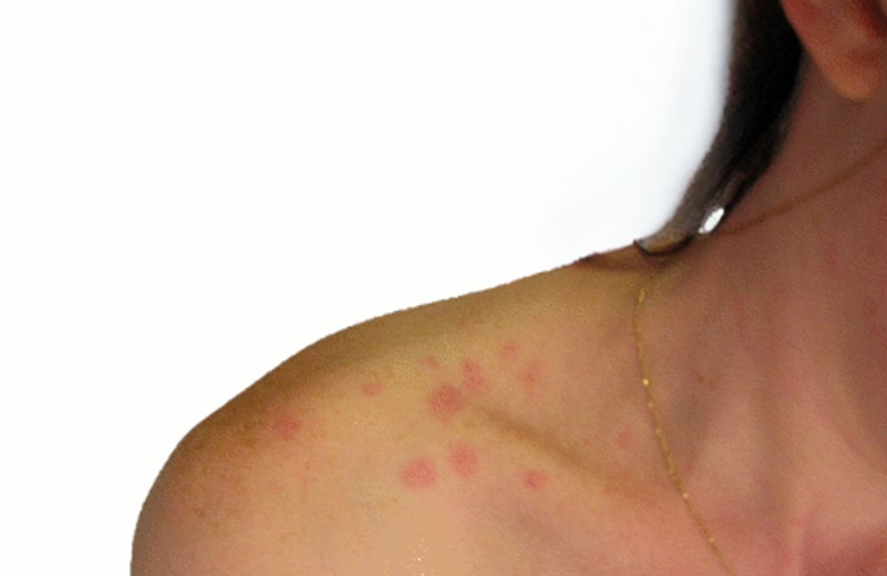 pogryzienia-pluskiew-szyja-ramiona