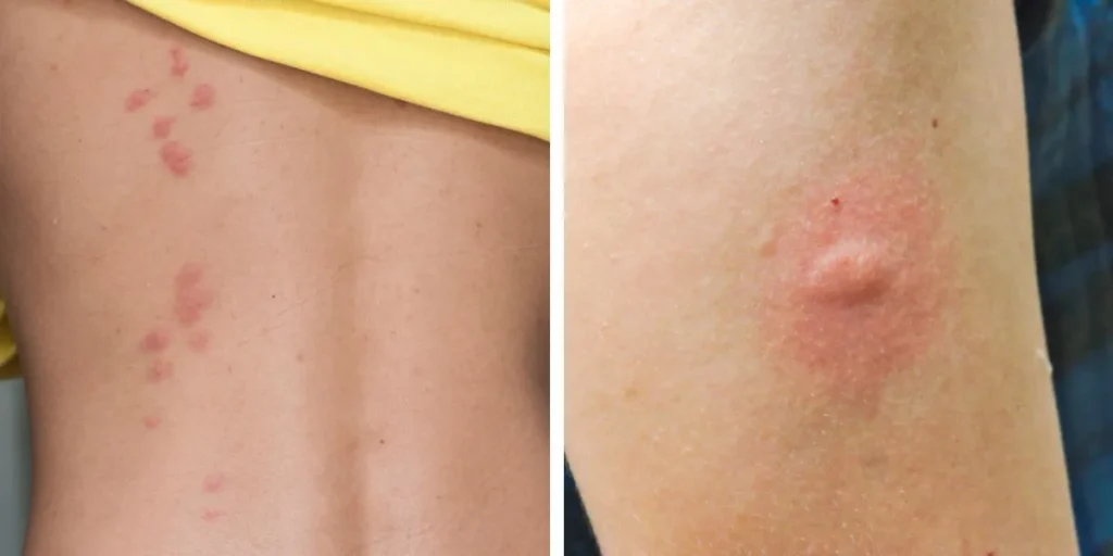 ukaszenie-pluskwy-a-komara-zdjecia-porownanie