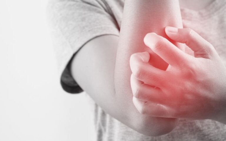 infekcja-alergia-rana-od-pluskwy