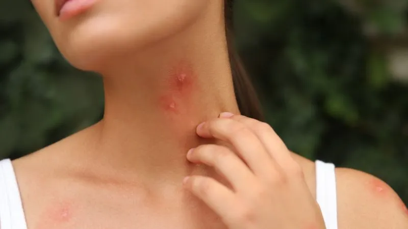 choroby-po-ukaszeniu-komarow