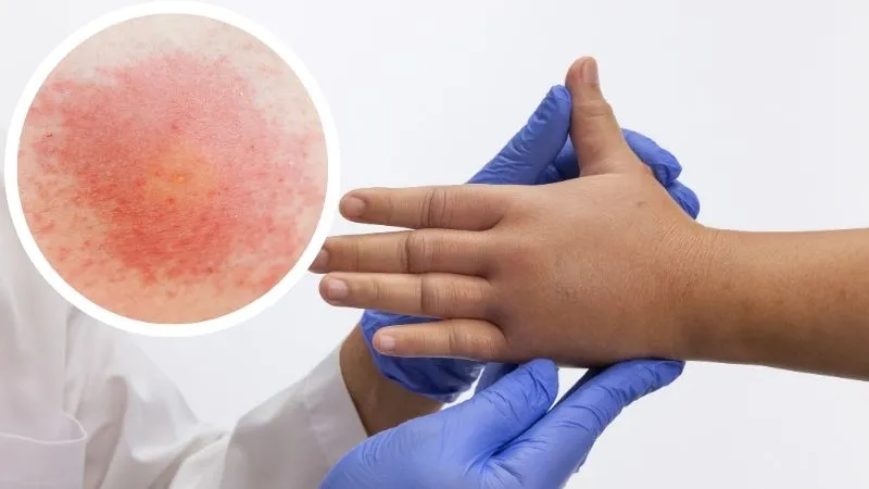 jak-wyglada-uzadlenie-szerszenia