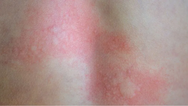 rumien-objaw-choroby-wywolywanej-przez-kleszcze