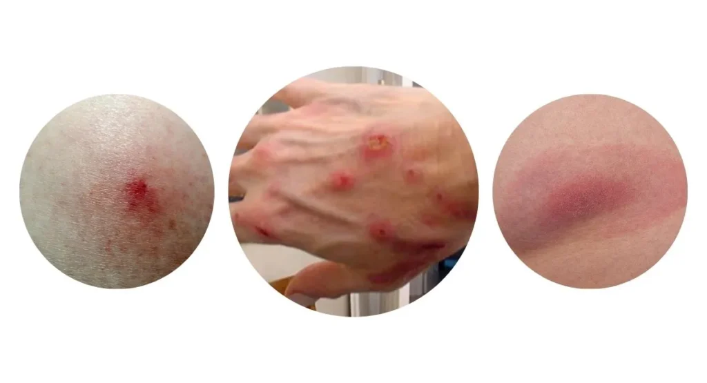 jak-wygląda-ugryziene-obzeżka-jakie-są-objawy