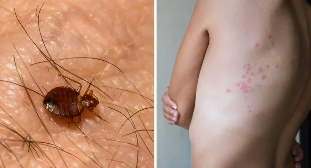 ugryzienia-pluskiew-ślady-na-skórze