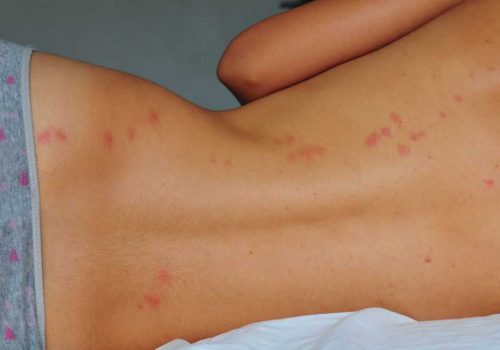 pluskwa-ugryzienia-zdjecie